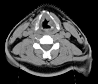 Initial CT scan